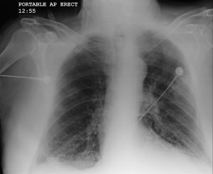 An x-ray of someone with Chronic Obstructive Pulmonary Disease (COPD)